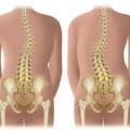Escoliosis