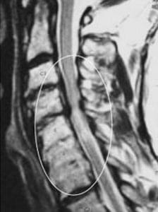 Canal Cervical Estrecho (CCE)