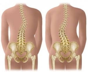 Escoliosis
