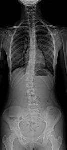 Espinografia con escoliosis