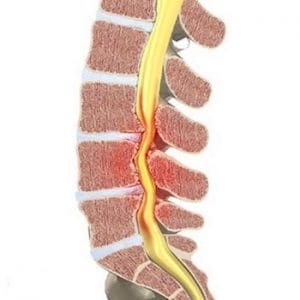 Canal Lumbar Estrecho