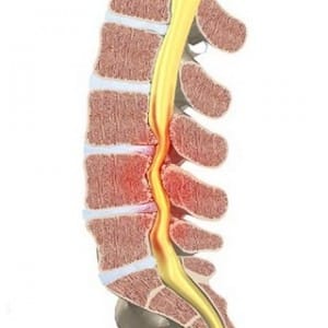 Canal Lumbar Estrecho