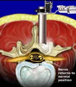hernia de disco discectomía video endoscópica