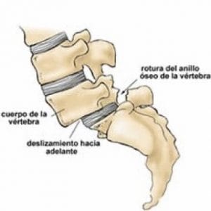 Espondilolistesis Lumbar