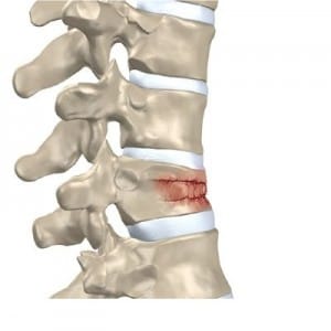 fractura aplastamiento vertebral