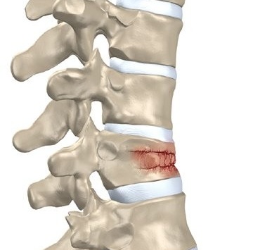 fractura aplastamiento vertebral