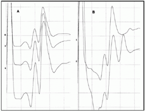 Potenciales Evocados Somatosensitivos