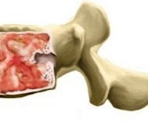 Tumores óseos de la Columna