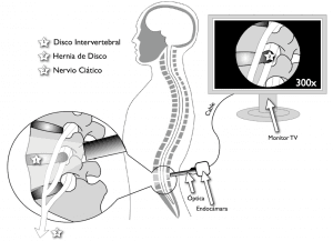 video endoscopía Hernia de disco