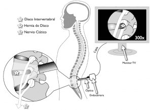 video endoscopía Hernia de disco