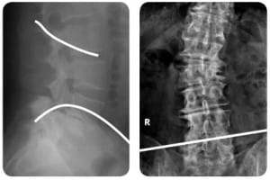 Dlif reparos anatomicos