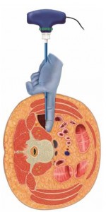 Dlif abordaje trans psoas