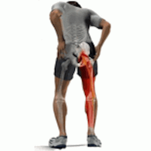 Dolor ciático (ciatalgia)