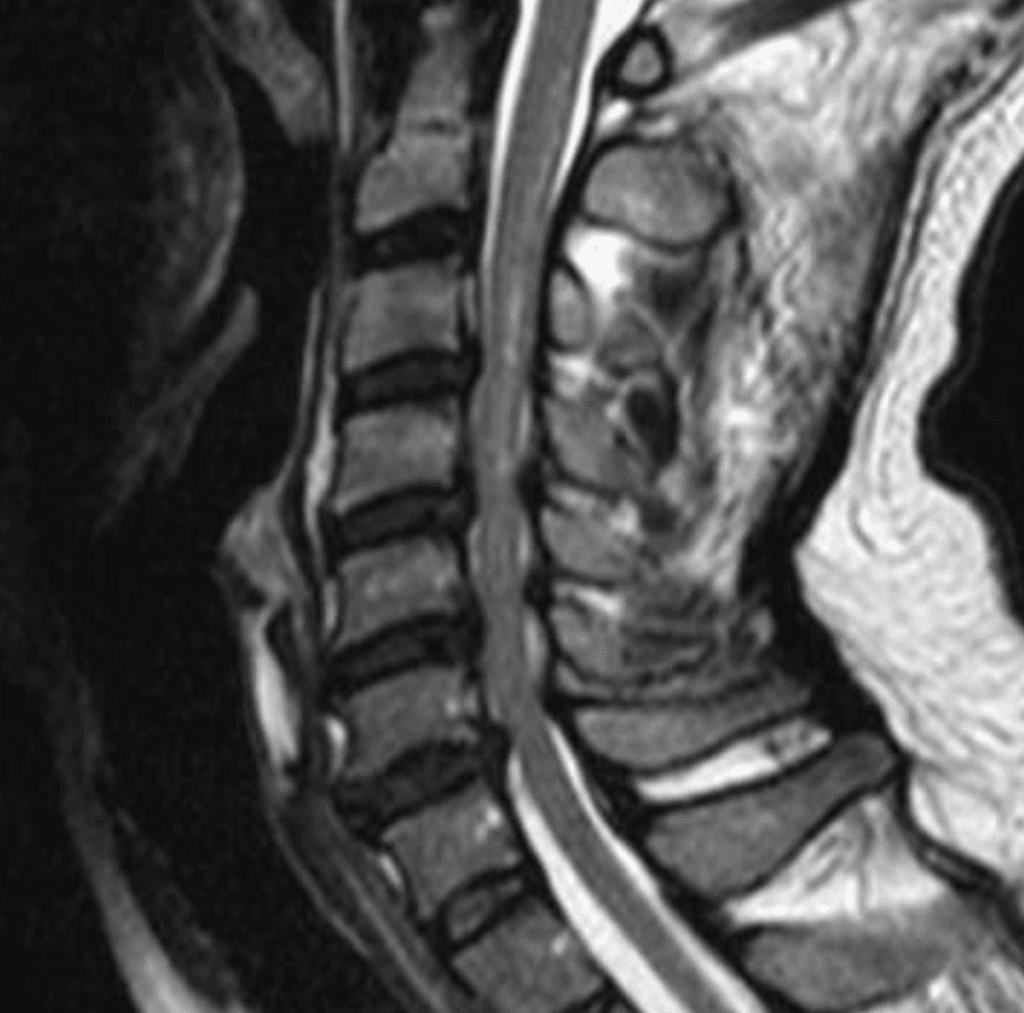 Canal cervical estrecho laminoplastia