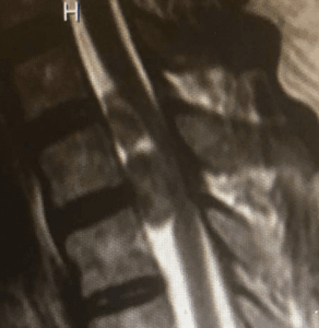 Shwannoma dorsal pre medular