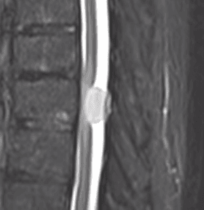 Meningioma dorsal espinal