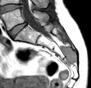 Cordoba sacro coccigeo