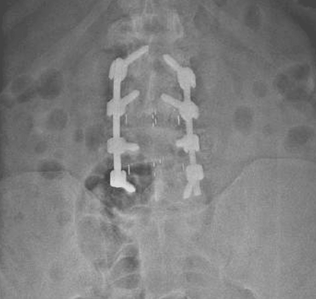 Escoliosis del adulto descompensada OLIF