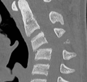 Fractura cervical tipo C con luxación facetaria