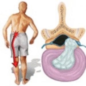Hernia de Disco Lumbar