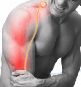 Hernia de disco cervical