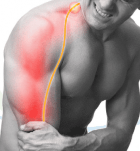 hernia de disco cervical