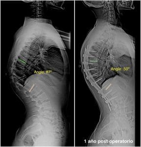 Enfermedad de Scheuermann